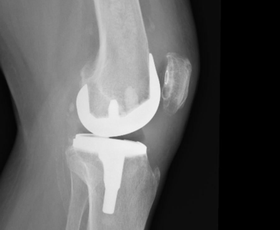 Artroplastia total de rodilla